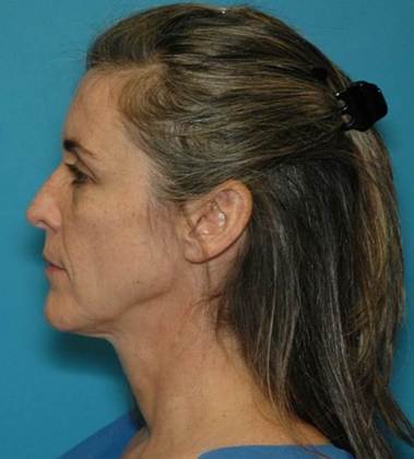 Before Image: Mini Facelift: Case 5 - left-side