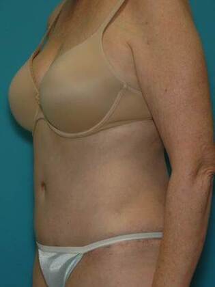 After Image: Abdominoplasty: Case 5 - left-front-oblique