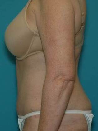 After Image: Abdominoplasty: Case 5 - left-side