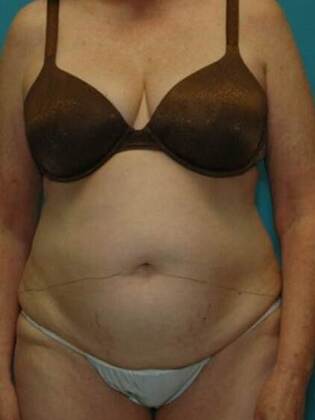 Before Image: Abdominoplasty: Case 5 - front