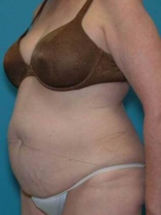 Before Image: Abdominoplasty: Case 5 - left-front-oblique