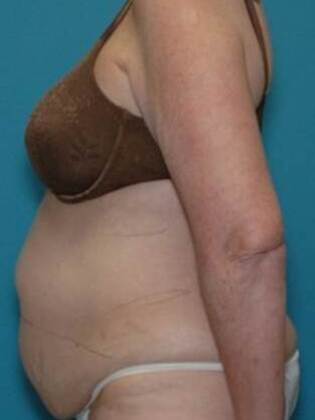Before Image: Abdominoplasty: Case 5 - left-side