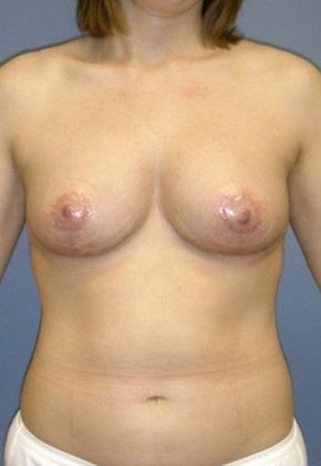 After Image: Breast Lift: Case 5 - front
