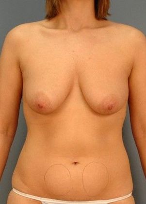 Before Image: Breast Lift: Case 5 - front
