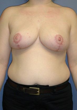 After Image: Breast Reduction: Case 5 - front