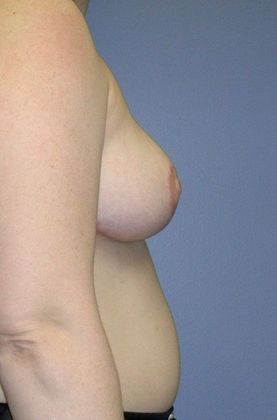 After Image: Breast Reduction: Case 5 - right-side