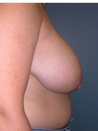 Before Image: Breast Reduction: Case 5 - right-side