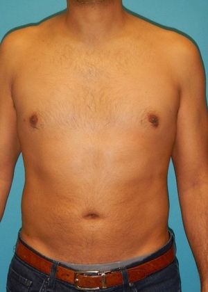 After Image: Liposuction: Case 5 - front