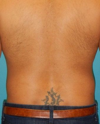 After Image: Liposuction: Case 5 - back