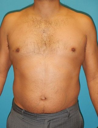 Before Image: Liposuction: Case 5 - front