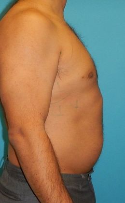 Before Image: Liposuction: Case 5 - right-side