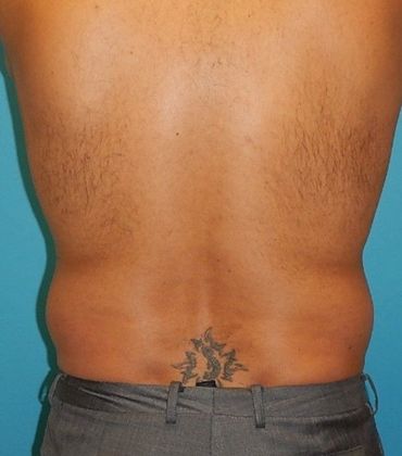 Before Image: Liposuction: Case 5 - back