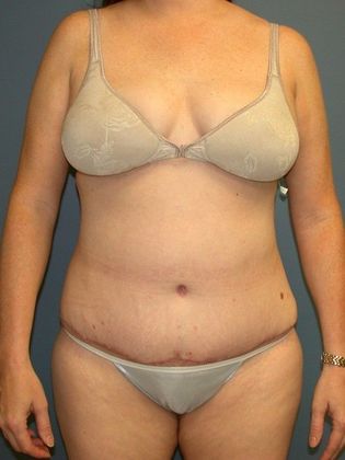 After Image: Body Lifts: Case 5 - front