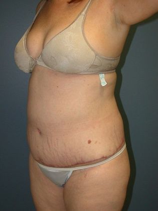 After Image: Body Lifts: Case 5 - left-front-oblique