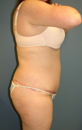 After Image: Body Lifts: Case 5 - right-side