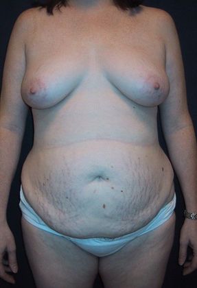 Before Image: Body Lifts: Case 5 - front