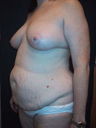 Before Image: Body Lifts: Case 5 - left-front-oblique