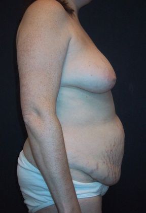 Before Image: Body Lifts: Case 5 - right-side