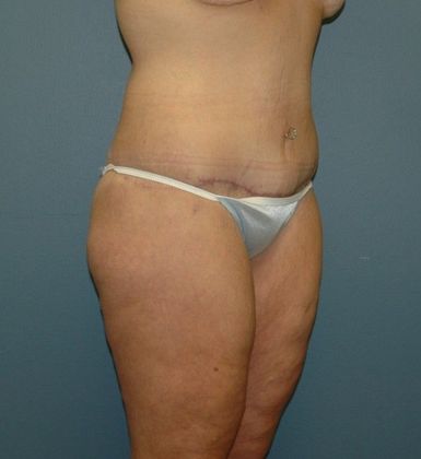 After Image: Thigh Lift: Case 5 - right-front-oblique