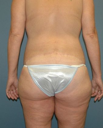 After Image: Thigh Lift: Case 5 - back