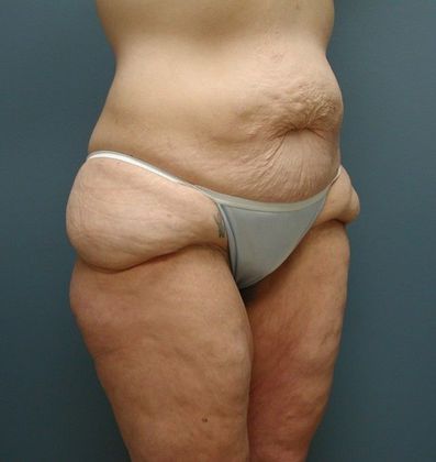 Before Image: Thigh Lift: Case 5 - right-front-oblique