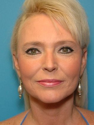 Before Image: Brow Lift: Case 5 - front
