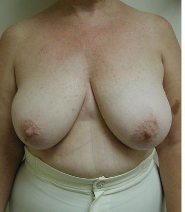 Before Image: Breast Reconstruction: Case 5 - front