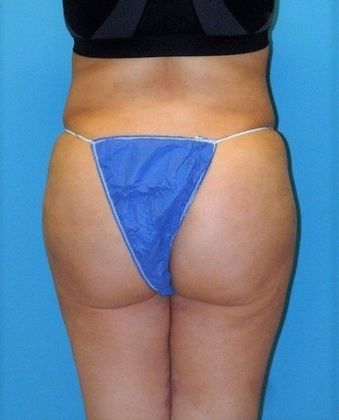 After Image: Brazilian Butt Lift: Case 5 - back