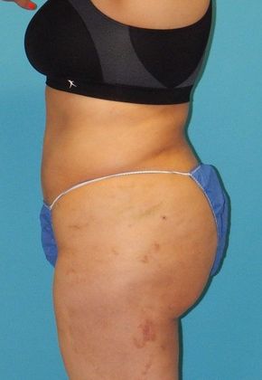 After Image: Brazilian Butt Lift: Case 5 - left-side