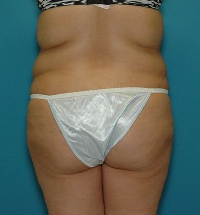 Before Image: Brazilian Butt Lift: Case 5 - back