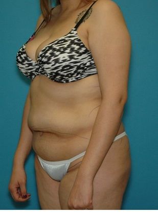 Before Image: Brazilian Butt Lift: Case 5 - left-front-oblique