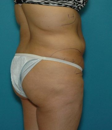 Before Image: Brazilian Butt Lift: Case 5 - right-back-oblique