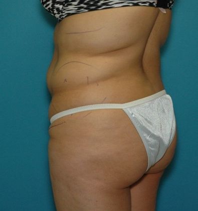 Before Image: Brazilian Butt Lift: Case 5 - left-back-oblique