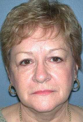 After Image: Eye Lift (Blepharoplasty): Case 5 - front