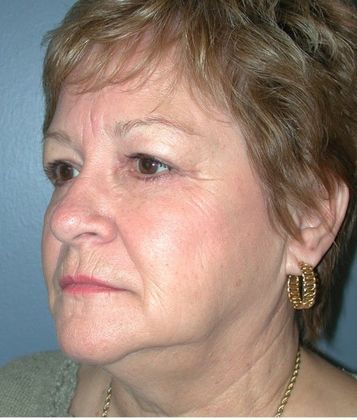 After Image: Eye Lift (Blepharoplasty): Case 5 - left-front-oblique