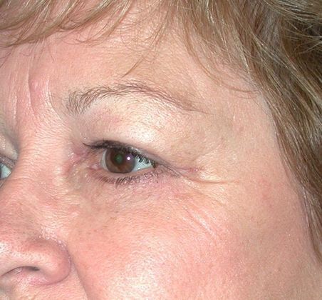 After Image: Eye Lift (Blepharoplasty): Case 5 - left-front-oblique