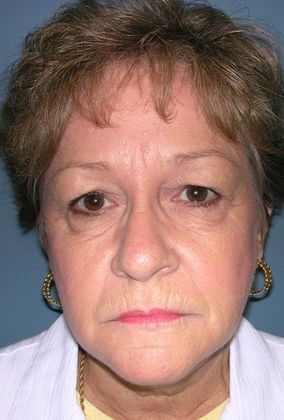 Before Image: Eye Lift (Blepharoplasty): Case 5 - front