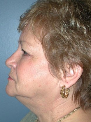 Before Image: Eye Lift (Blepharoplasty): Case 5 - left-side