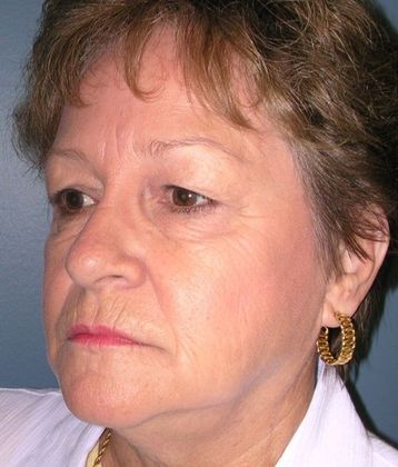 Before Image: Eye Lift (Blepharoplasty): Case 5 - left-front-oblique