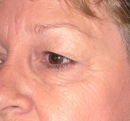 Before Image: Eye Lift (Blepharoplasty): Case 5 - left-front-oblique