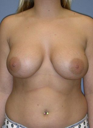 After Image: Breast Augmentation: Case 5 - front