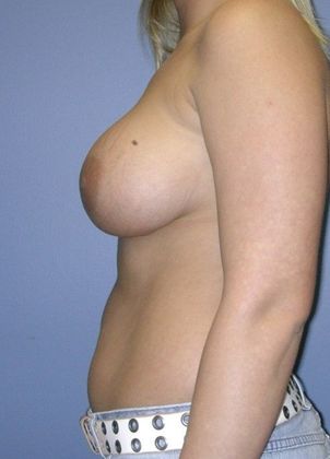After Image: Breast Augmentation: Case 5 - left-side