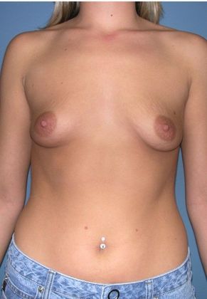 Before Image: Breast Augmentation: Case 5 - front