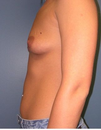 Before Image: Breast Augmentation: Case 5 - left-side