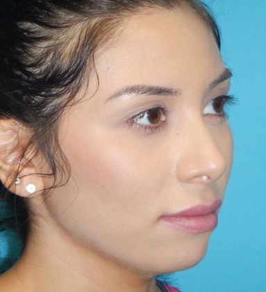 After Image: Soft Tissue Fillers: Case 5 - right-front-oblique