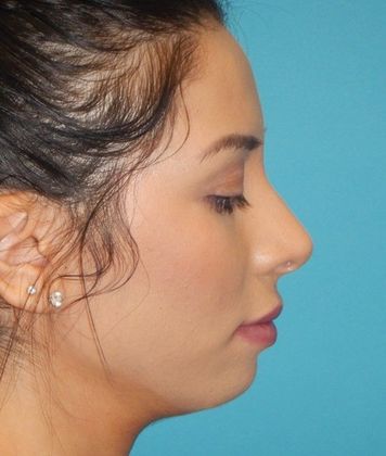 After Image: Soft Tissue Fillers: Case 5 - right-side