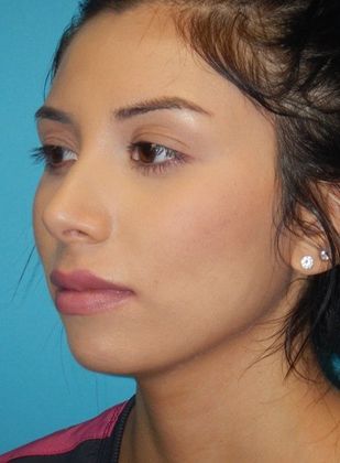 After Image: Soft Tissue Fillers: Case 5 - left-front-oblique