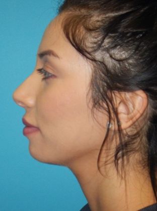 After Image: Soft Tissue Fillers: Case 5 - left-side
