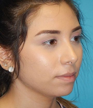 Before Image: Soft Tissue Fillers: Case 5 - right-front-oblique