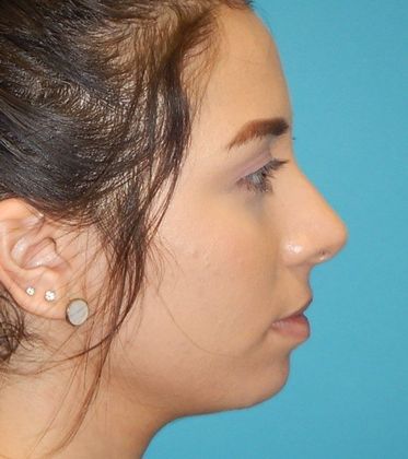 Before Image: Soft Tissue Fillers: Case 5 - right-side